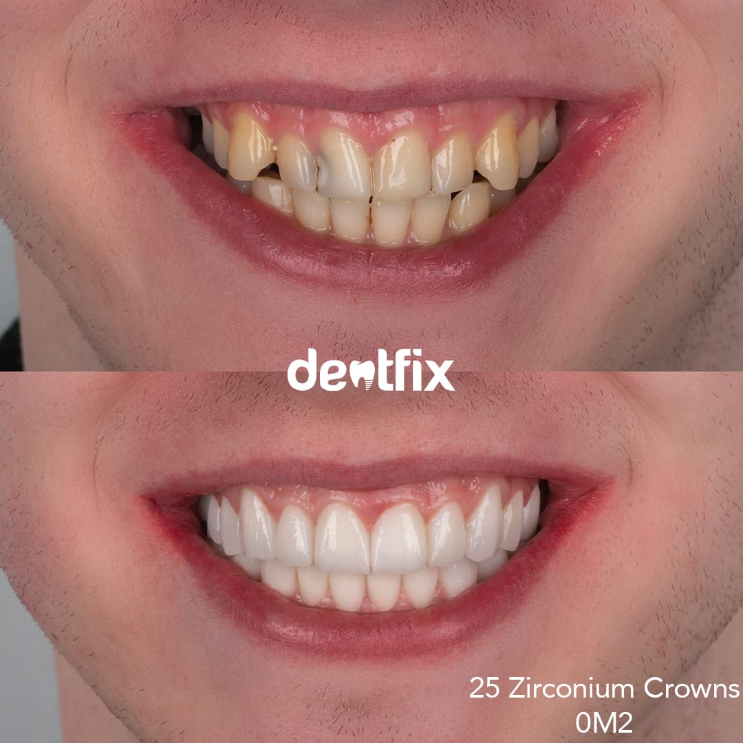 Before and after example