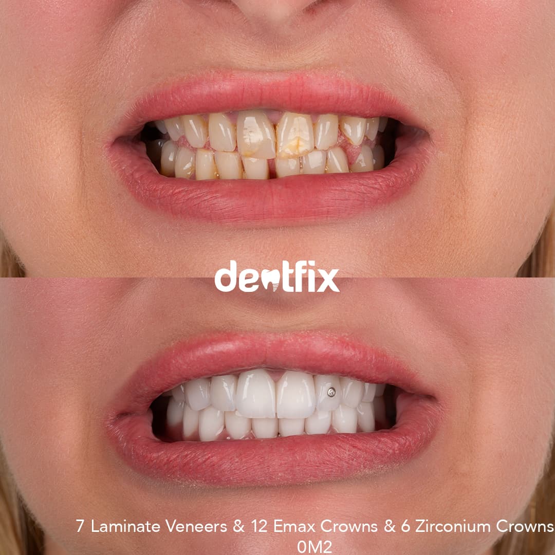 Before and after example