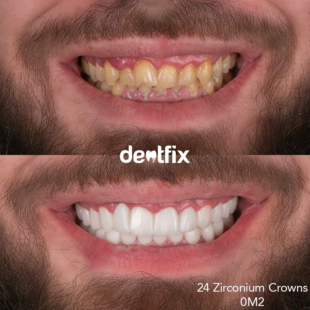 Before and after example